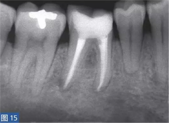 根尖周炎的病因與癥狀根尖周炎的病因與癥狀 根尖周炎的病因與癥狀根尖周炎的病因與癥狀