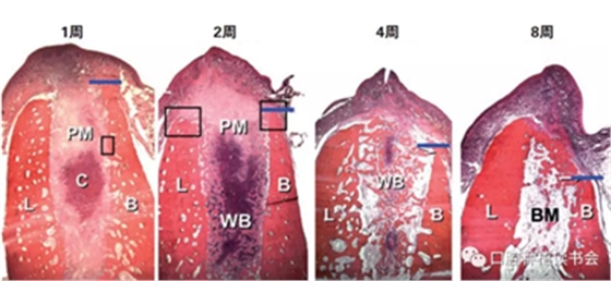 血液衍生物PRF&CGF在牙槽窩處理中的應(yīng)用 血液衍生物PRF&CGF在牙槽窩處理中的應(yīng)用