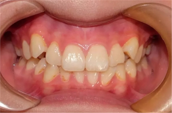 正畸矯正 正畸矯正