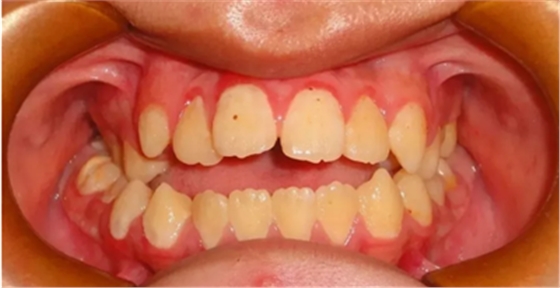 正畸矯正 正畸矯正