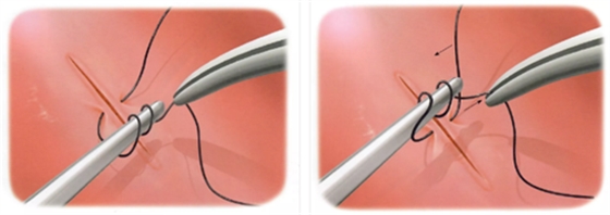 牙周顯微手術(shù)-翻瓣基礎(chǔ) 牙周顯微手術(shù)-翻瓣基礎(chǔ)