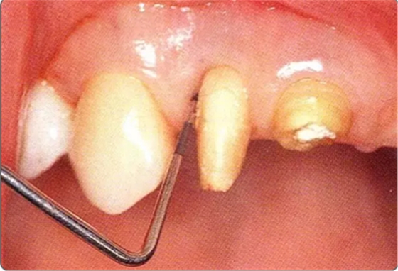 深牙周袋的治療 深牙周袋的治療