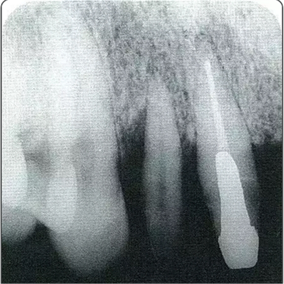 深牙周袋的治療 深牙周袋的治療