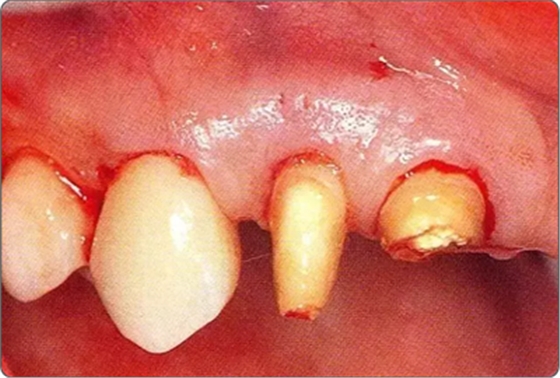 深牙周袋的治療 深牙周袋的治療