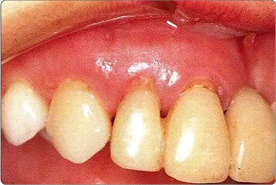 深牙周袋的治療 深牙周袋的治療