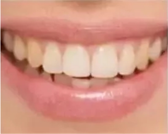 瓷貼面修復(fù)體最終顏色的影響因素 瓷貼面修復(fù)體最終顏色的影響因素