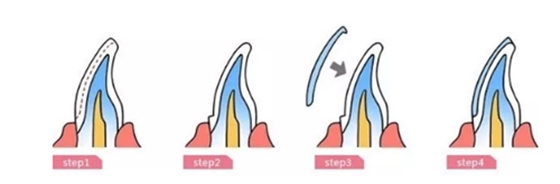 瓷貼面修復(fù)體最終顏色的影響因素 瓷貼面修復(fù)體最終顏色的影響因素