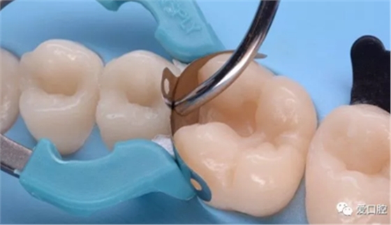 復(fù)合樹脂直接粘接牙體修復(fù)技術(shù)臨床常見問題及處理 復(fù)合樹脂直接粘接牙體修復(fù)技術(shù)臨床常見問題及處理