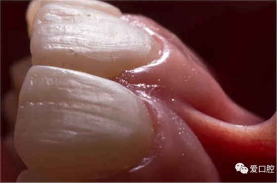 復(fù)合樹脂直接粘接牙體修復(fù)技術(shù)臨床常見問題及處理 復(fù)合樹脂直接粘接牙體修復(fù)技術(shù)臨床常見問題及處理