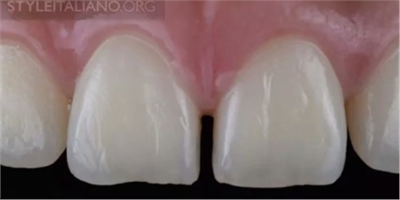 【分享】前翼技術(shù)關(guān)閉前牙間隙 【分享】前翼技術(shù)關(guān)閉前牙間隙