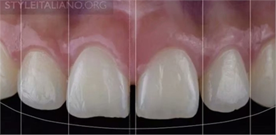 【分享】前翼技術(shù)關(guān)閉前牙間隙 【分享】前翼技術(shù)關(guān)閉前牙間隙