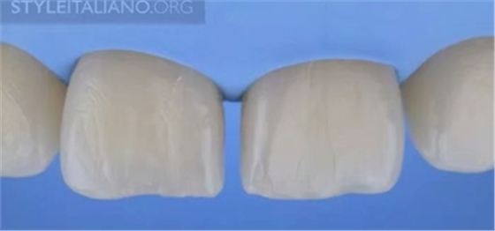 【分享】前翼技術(shù)關(guān)閉前牙間隙 【分享】前翼技術(shù)關(guān)閉前牙間隙