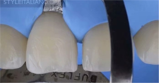 【分享】前翼技術(shù)關(guān)閉前牙間隙 【分享】前翼技術(shù)關(guān)閉前牙間隙