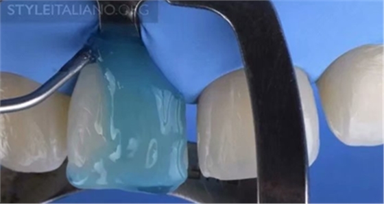 【分享】前翼技術(shù)關(guān)閉前牙間隙 【分享】前翼技術(shù)關(guān)閉前牙間隙