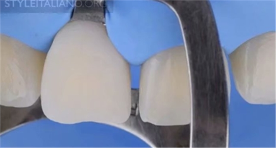 【分享】前翼技術(shù)關(guān)閉前牙間隙 【分享】前翼技術(shù)關(guān)閉前牙間隙