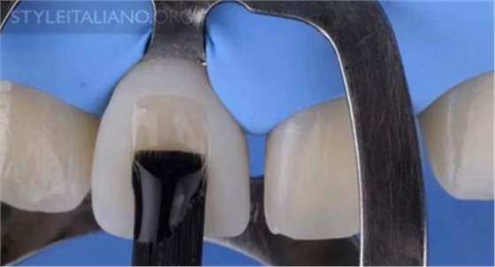 【分享】前翼技術(shù)關(guān)閉前牙間隙 【分享】前翼技術(shù)關(guān)閉前牙間隙