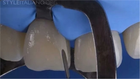 【分享】前翼技術(shù)關(guān)閉前牙間隙 【分享】前翼技術(shù)關(guān)閉前牙間隙