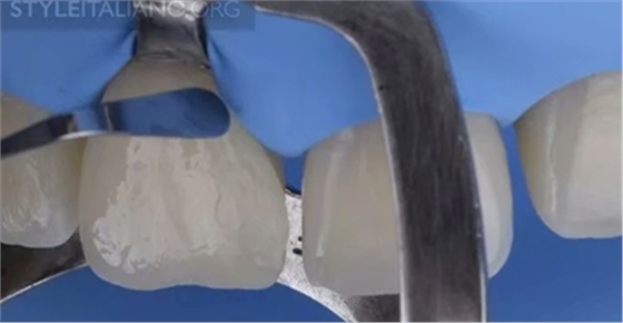 【分享】前翼技術(shù)關(guān)閉前牙間隙 【分享】前翼技術(shù)關(guān)閉前牙間隙