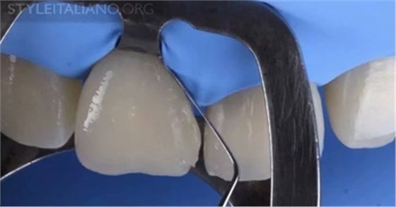 【分享】前翼技術(shù)關(guān)閉前牙間隙 【分享】前翼技術(shù)關(guān)閉前牙間隙