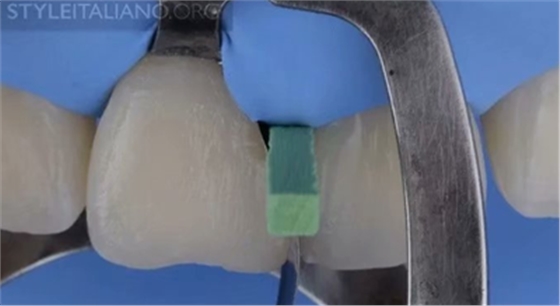 【分享】前翼技術(shù)關(guān)閉前牙間隙 【分享】前翼技術(shù)關(guān)閉前牙間隙