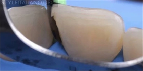 【分享】前翼技術(shù)關(guān)閉前牙間隙 【分享】前翼技術(shù)關(guān)閉前牙間隙