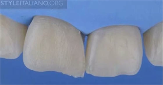 【分享】前翼技術(shù)關(guān)閉前牙間隙 【分享】前翼技術(shù)關(guān)閉前牙間隙