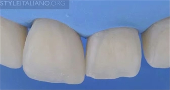 【分享】前翼技術(shù)關(guān)閉前牙間隙 【分享】前翼技術(shù)關(guān)閉前牙間隙