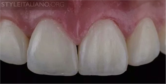 【分享】前翼技術(shù)關(guān)閉前牙間隙 【分享】前翼技術(shù)關(guān)閉前牙間隙