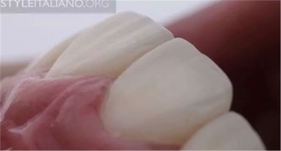 【分享】前翼技術(shù)關(guān)閉前牙間隙 【分享】前翼技術(shù)關(guān)閉前牙間隙