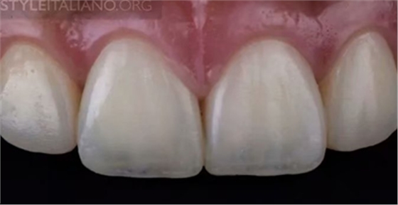 【分享】前翼技術(shù)關(guān)閉前牙間隙 【分享】前翼技術(shù)關(guān)閉前牙間隙