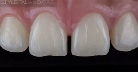 【分享】前翼技術(shù)關(guān)閉前牙間隙 【分享】前翼技術(shù)關(guān)閉前牙間隙