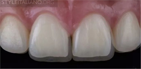 【分享】前翼技術(shù)關(guān)閉前牙間隙 【分享】前翼技術(shù)關(guān)閉前牙間隙