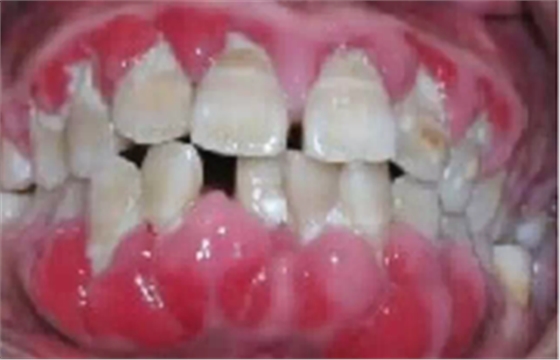 什么叫牙周病 | 品瑞邁格磁致伸縮治療儀保駕護航 什么叫牙周病 | 品瑞邁格磁致伸縮治療儀保駕護航