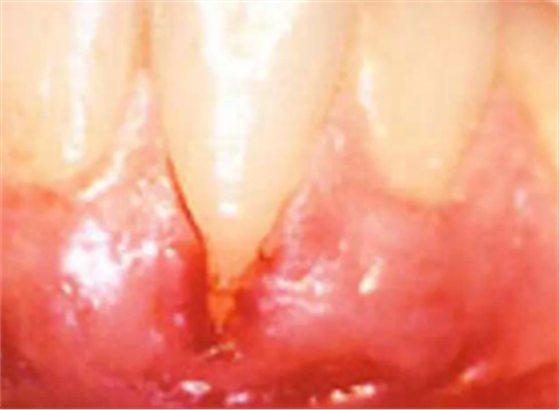 什么叫牙周病 什么叫牙周病