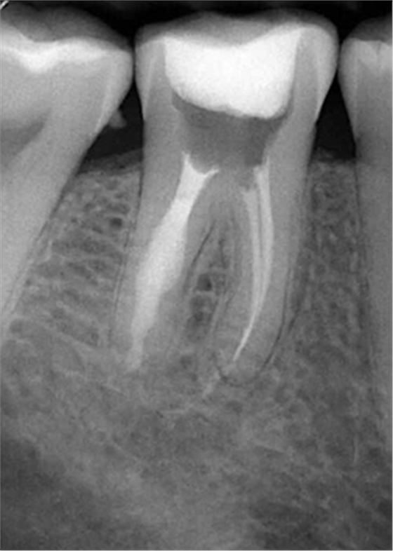 內(nèi)吸收 內(nèi)吸收