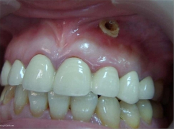 根尖囊腫 根尖囊腫