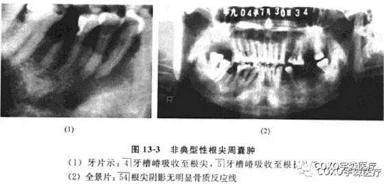 根尖周病的鑒別診斷 根尖周病的鑒別診斷