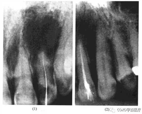 根尖周病的鑒別診斷 根尖周病的鑒別診斷