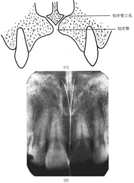 切牙管上孔 切牙管上孔