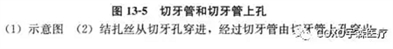 切牙管上孔 切牙管上孔
