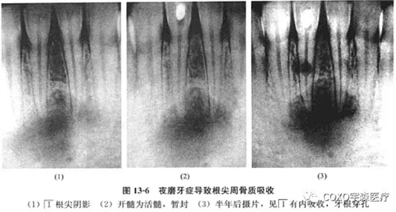 根尖周病與夜磨牙癥 根尖周病與夜磨牙癥