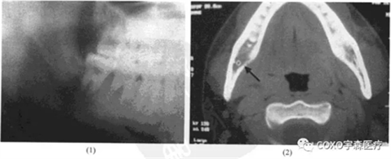 根尖周病的鑒別診斷 根尖周病的鑒別診斷