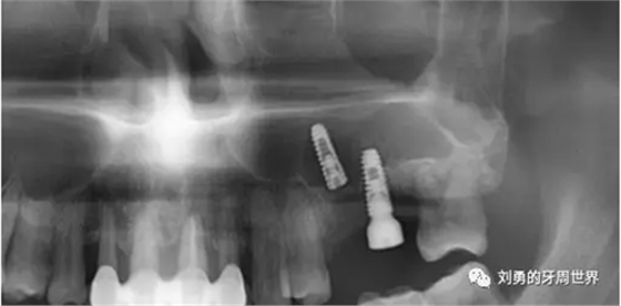 失敗上頜竇種植患者的補(bǔ)救 失敗上頜竇種植患者的補(bǔ)救