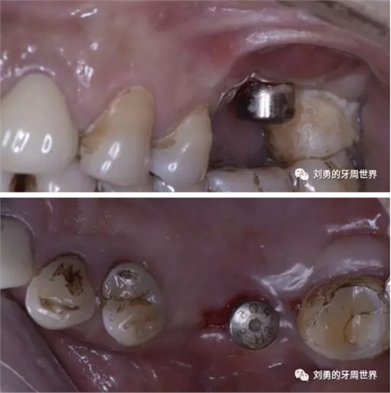 一例失敗上頜竇種植患者的補(bǔ)救 一例失敗上頜竇種植患者的補(bǔ)救