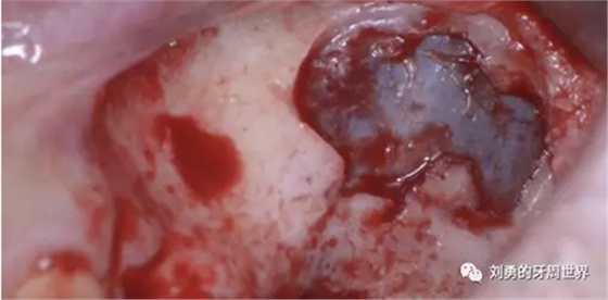 一例失敗上頜竇種植患者的補(bǔ)救 一例失敗上頜竇種植患者的補(bǔ)救