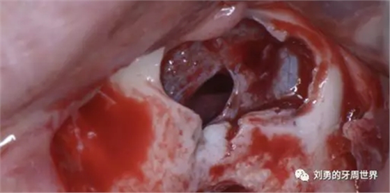 一例失敗上頜竇種植患者的補(bǔ)救 一例失敗上頜竇種植患者的補(bǔ)救