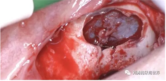 一例失敗上頜竇種植患者的補(bǔ)救 一例失敗上頜竇種植患者的補(bǔ)救