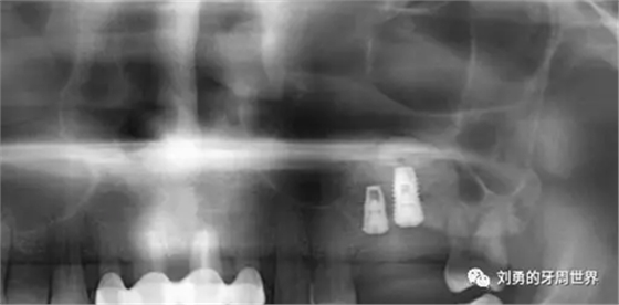 一例失敗上頜竇種植患者的補(bǔ)救 一例失敗上頜竇種植患者的補(bǔ)救