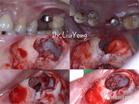 一例失敗上頜竇種植患者的補(bǔ)救 一例失敗上頜竇種植患者的補(bǔ)救