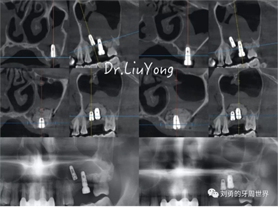 一例失敗上頜竇種植患者的補(bǔ)救 一例失敗上頜竇種植患者的補(bǔ)救